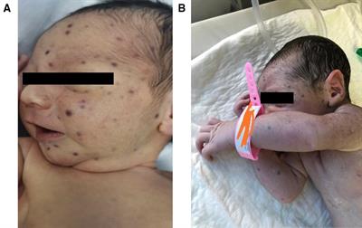 Case report: “Congenital cutaneous langerhans cell histiocytosis presenting with blueberry Muffin Rash”